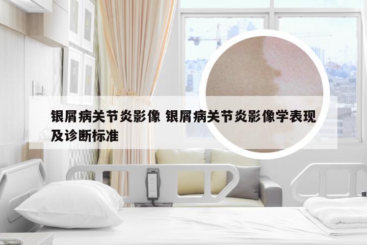 银屑病关节炎影像 银屑病关节炎影像学表现及诊断标准