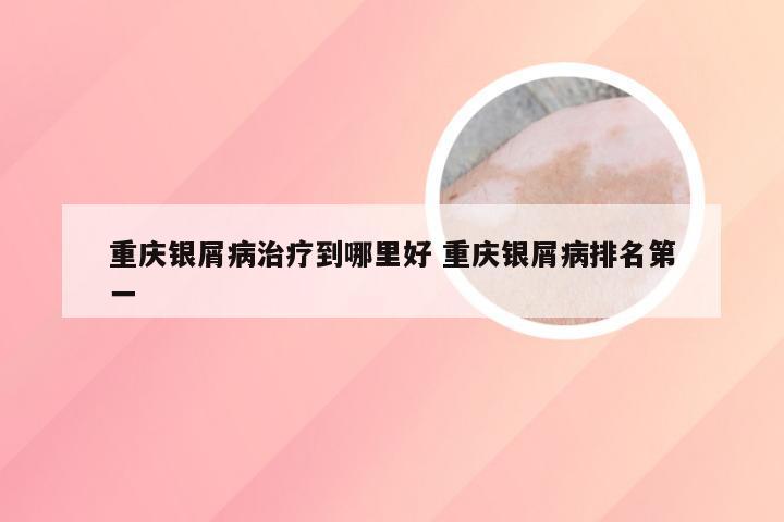 重庆银屑病治疗到哪里好 重庆银屑病排名第一