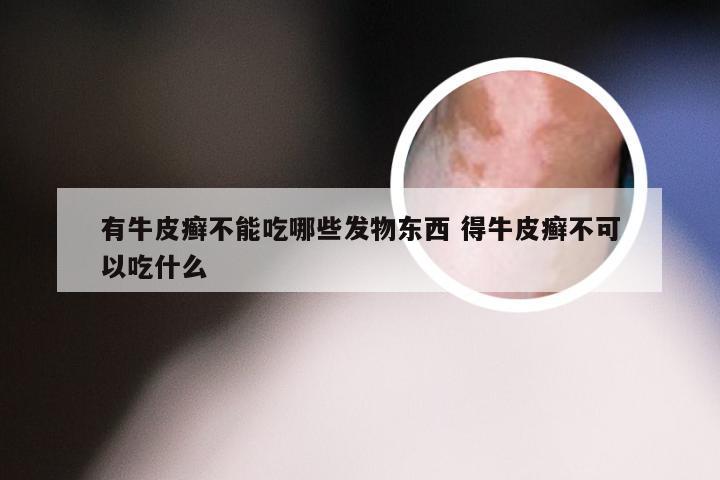 有牛皮癣不能吃哪些发物东西 得牛皮癣不可以吃什么