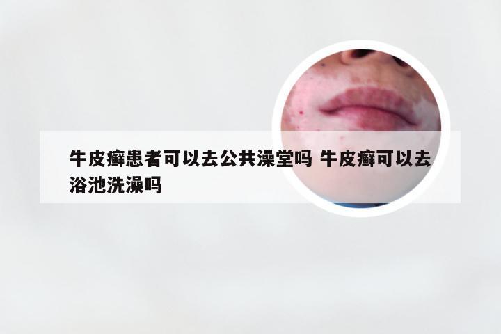 牛皮癣患者可以去公共澡堂吗 牛皮癣可以去浴池洗澡吗
