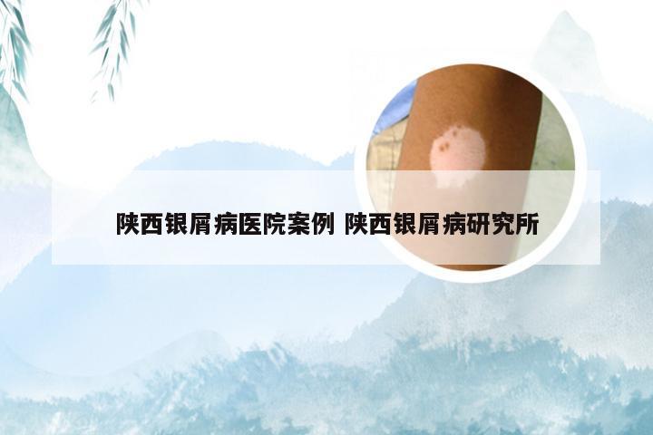 陕西银屑病医院案例 陕西银屑病研究所