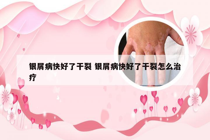 银屑病快好了干裂 银屑病快好了干裂怎么治疗