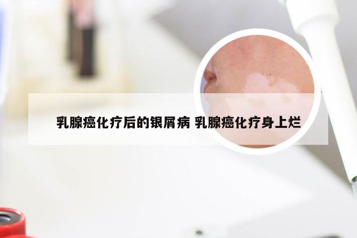 乳腺癌化疗后的银屑病 乳腺癌化疗身上烂