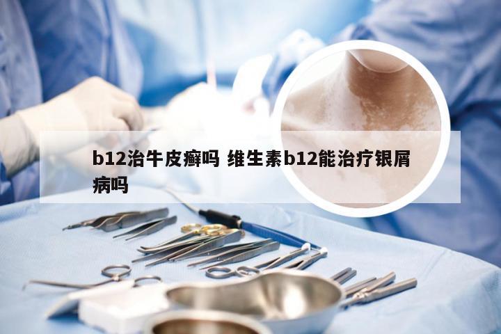 b12治牛皮癣吗 维生素b12能治疗银屑病吗