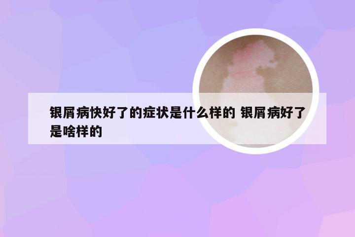 银屑病快好了的症状是什么样的 银屑病好了是啥样的