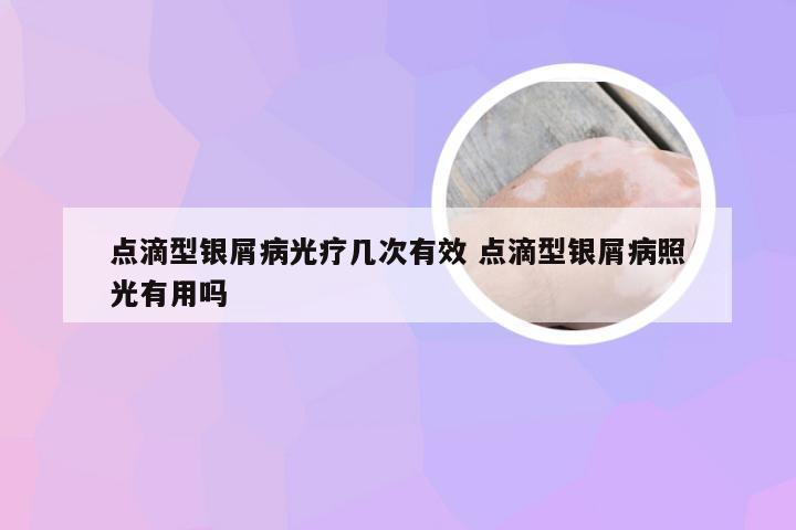 点滴型银屑病光疗几次有效 点滴型银屑病照光有用吗