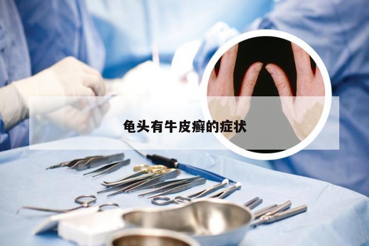 龟头有牛皮癣的症状