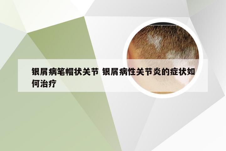 银屑病笔帽状关节 银屑病性关节炎的症状如何治疗