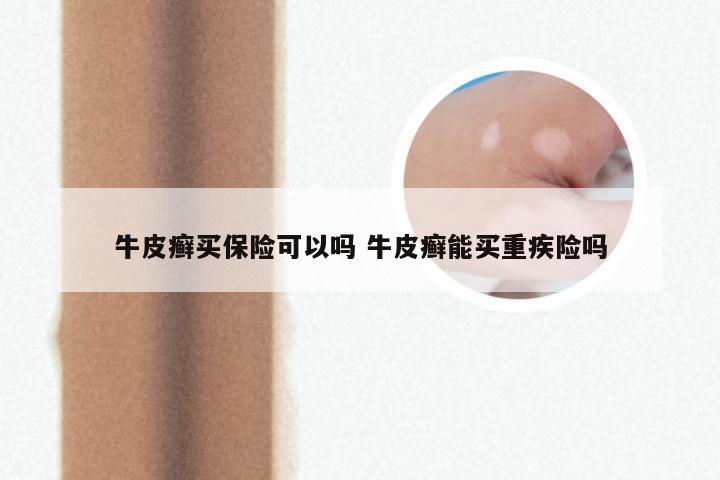 牛皮癣买保险可以吗 牛皮癣能买重疾险吗