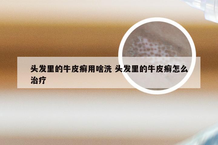 头发里的牛皮癣用啥洗 头发里的牛皮癣怎么治疗