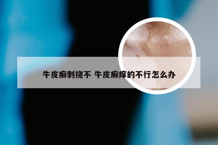 牛皮癣刺挠不 牛皮癣痒的不行怎么办