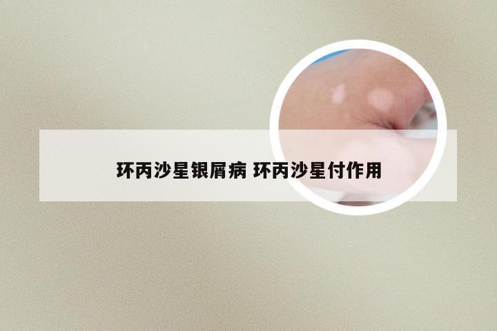 环丙沙星银屑病 环丙沙星付作用