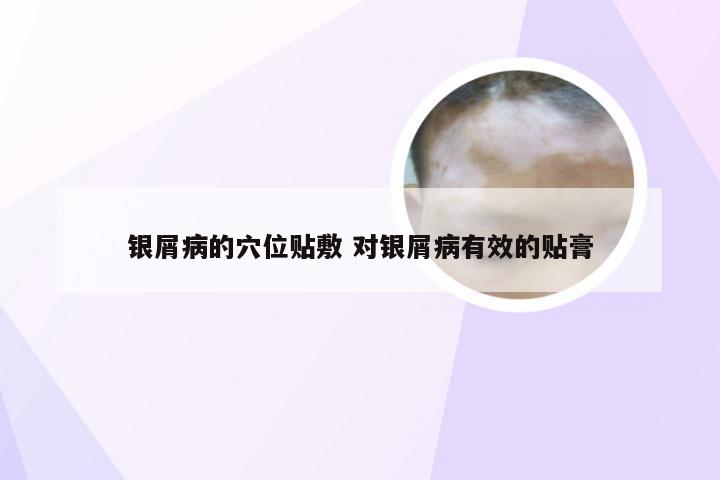 银屑病的穴位贴敷 对银屑病有效的贴膏