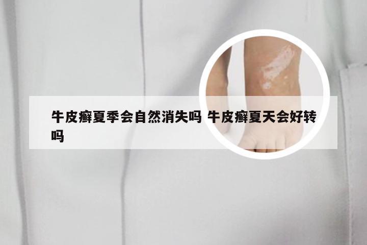 牛皮癣夏季会自然消失吗 牛皮癣夏天会好转吗
