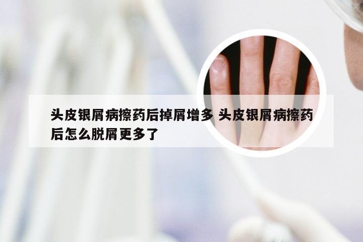 头皮银屑病擦药后掉屑增多 头皮银屑病擦药后怎么脱屑更多了