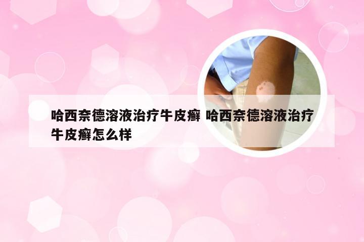 哈西奈德溶液治疗牛皮癣 哈西奈德溶液治疗牛皮癣怎么样
