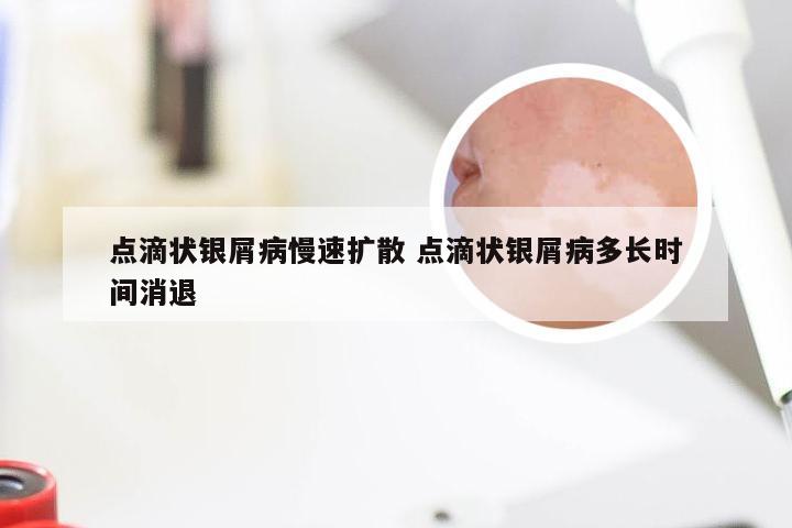 点滴状银屑病慢速扩散 点滴状银屑病多长时间消退