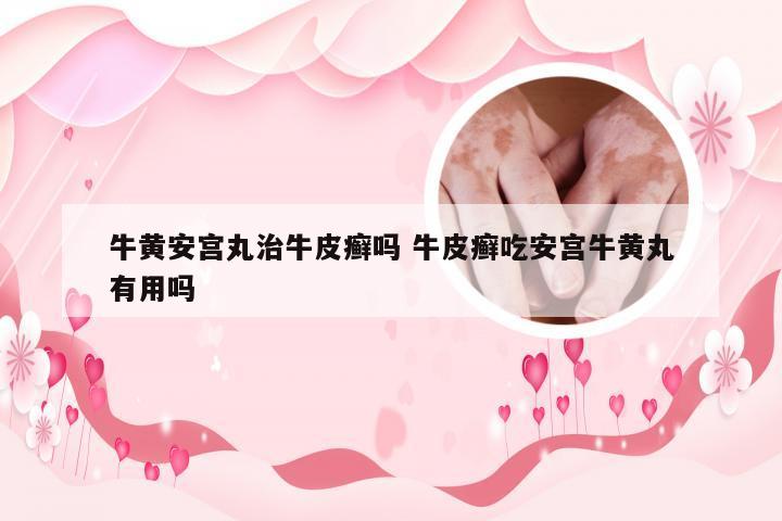 牛黄安宫丸治牛皮癣吗 牛皮癣吃安宫牛黄丸有用吗