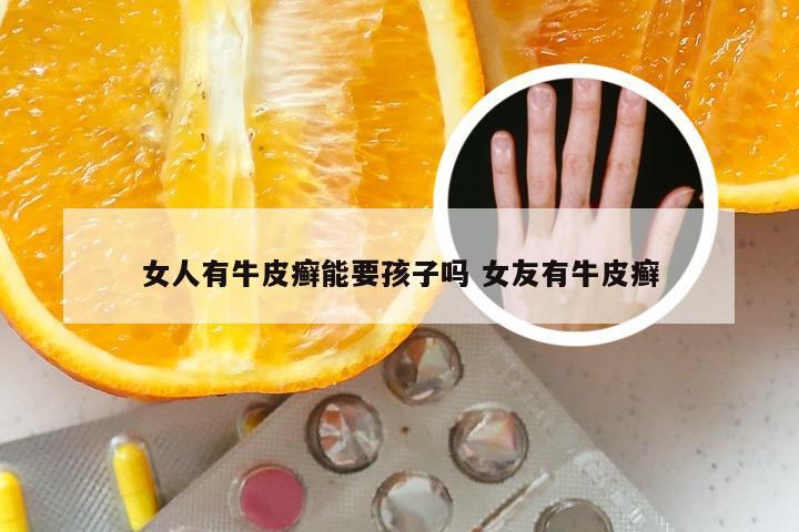 女人有牛皮癣能要孩子吗 女友有牛皮癣