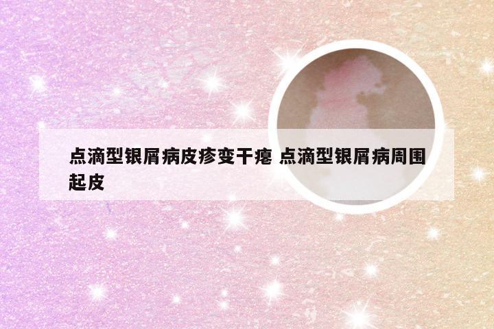 点滴型银屑病皮疹变干瘪 点滴型银屑病周围起皮