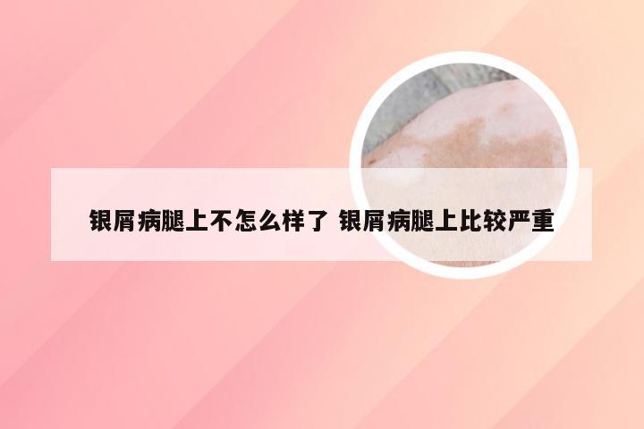 银屑病腿上不怎么样了 银屑病腿上比较严重