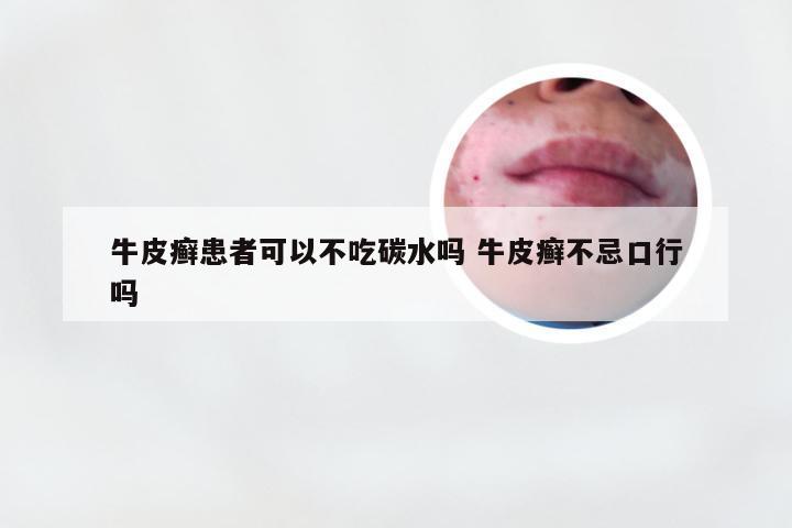 牛皮癣患者可以不吃碳水吗 牛皮癣不忌口行吗