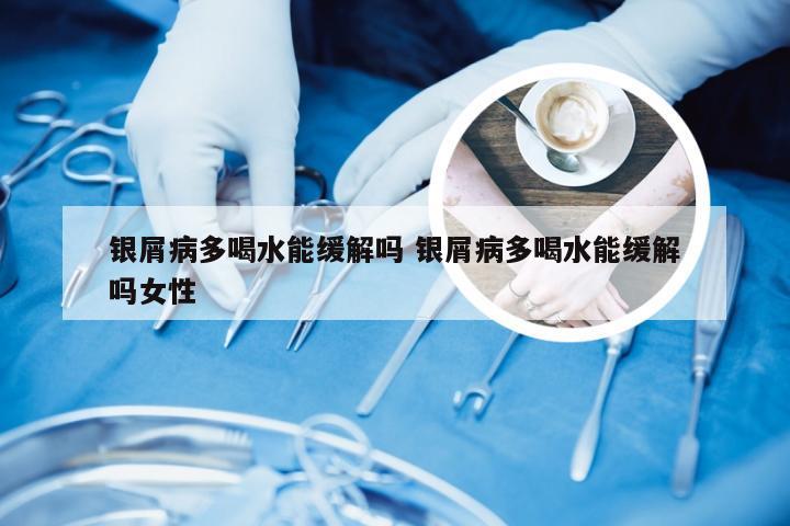 银屑病多喝水能缓解吗 银屑病多喝水能缓解吗女性