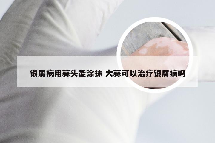 银屑病用蒜头能涂抹 大蒜可以治疗银屑病吗