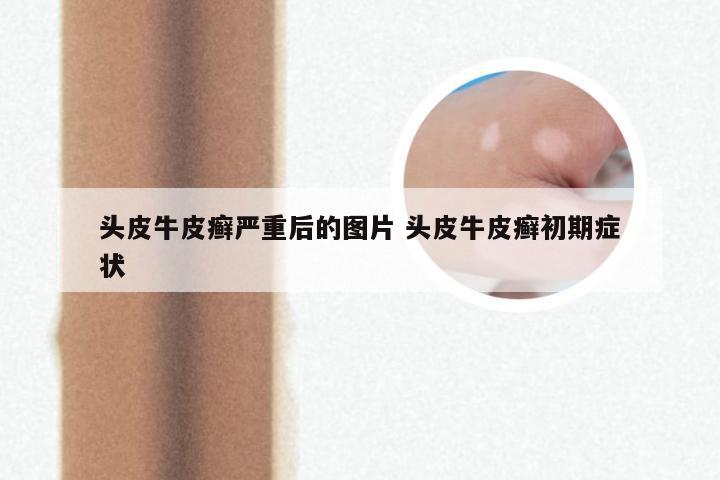 头皮牛皮癣严重后的图片 头皮牛皮癣初期症状