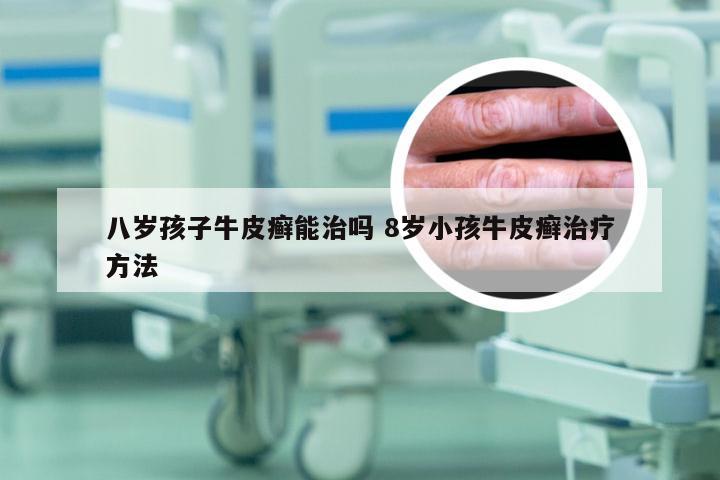 八岁孩子牛皮癣能治吗 8岁小孩牛皮癣治疗方法