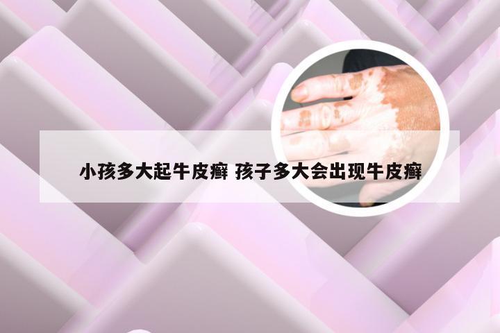 小孩多大起牛皮癣 孩子多大会出现牛皮癣