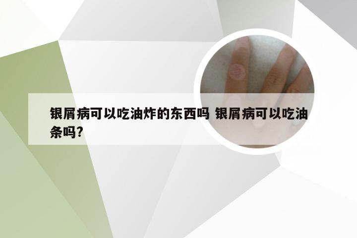 银屑病可以吃油炸的东西吗 银屑病可以吃油条吗?