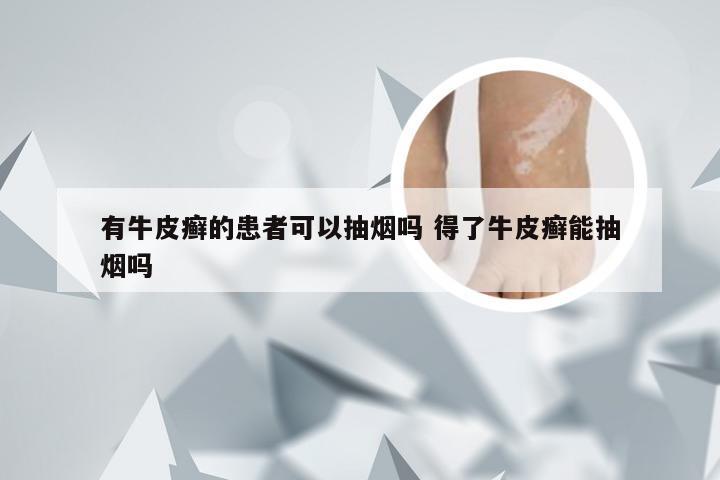 有牛皮癣的患者可以抽烟吗 得了牛皮癣能抽烟吗