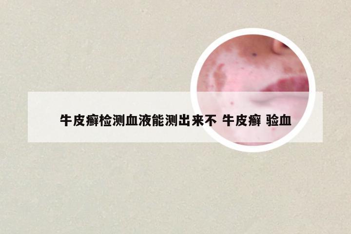 牛皮癣检测血液能测出来不 牛皮癣 验血
