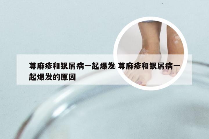 荨麻疹和银屑病一起爆发 荨麻疹和银屑病一起爆发的原因