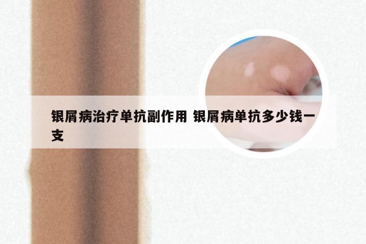 银屑病治疗单抗副作用 银屑病单抗多少钱一支