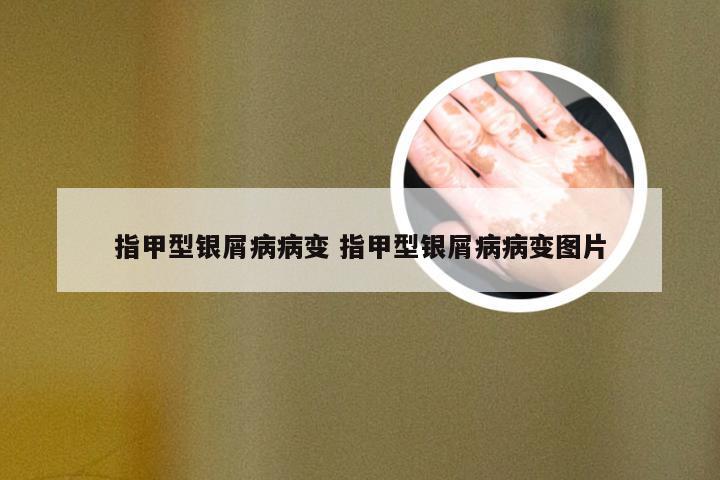 指甲型银屑病病变 指甲型银屑病病变图片
