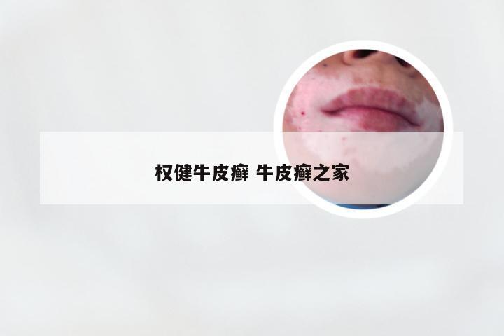 权健牛皮癣 牛皮癣之家
