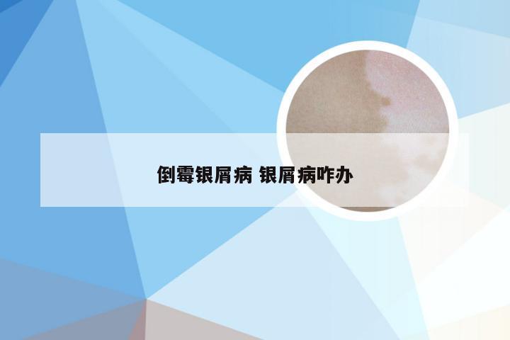 倒霉银屑病 银屑病咋办
