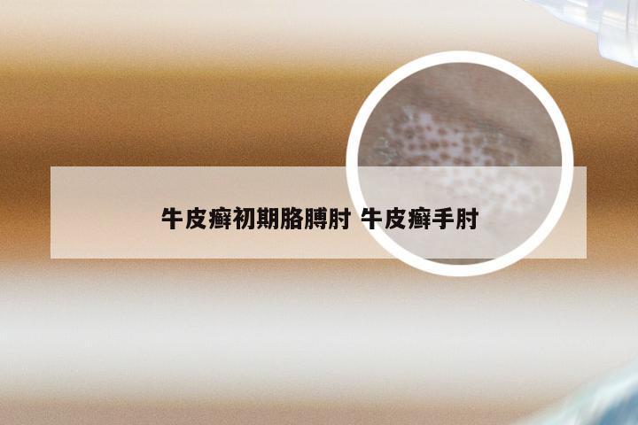 牛皮癣初期胳膊肘 牛皮癣手肘