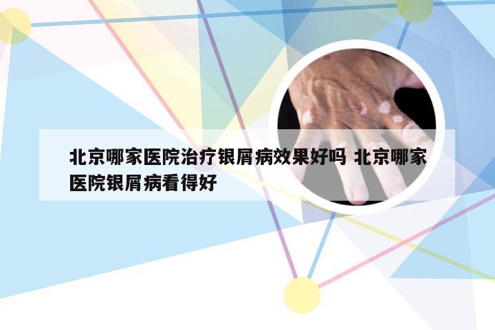 北京哪家医院治疗银屑病效果好吗 北京哪家医院银屑病看得好