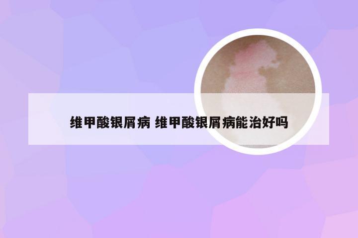 维甲酸银屑病 维甲酸银屑病能治好吗