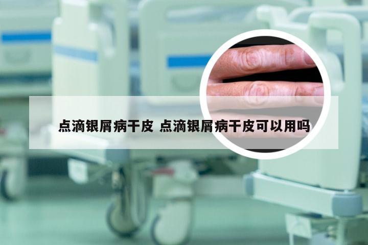 点滴银屑病干皮 点滴银屑病干皮可以用吗