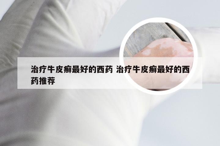 治疗牛皮癣最好的西药 治疗牛皮癣最好的西药推荐