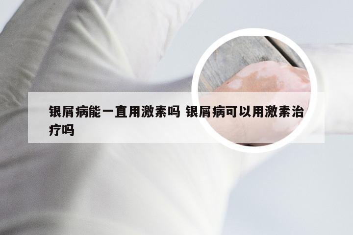 银屑病能一直用激素吗 银屑病可以用激素治疗吗