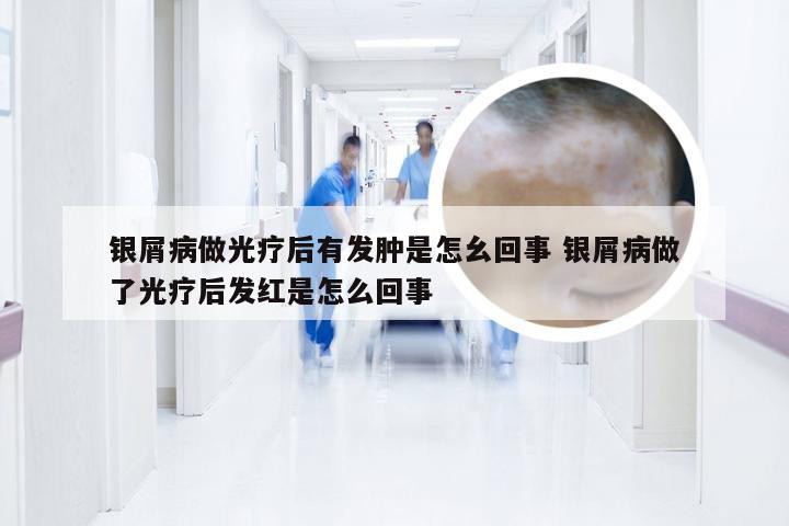 银屑病做光疗后有发肿是怎幺回事 银屑病做了光疗后发红是怎么回事