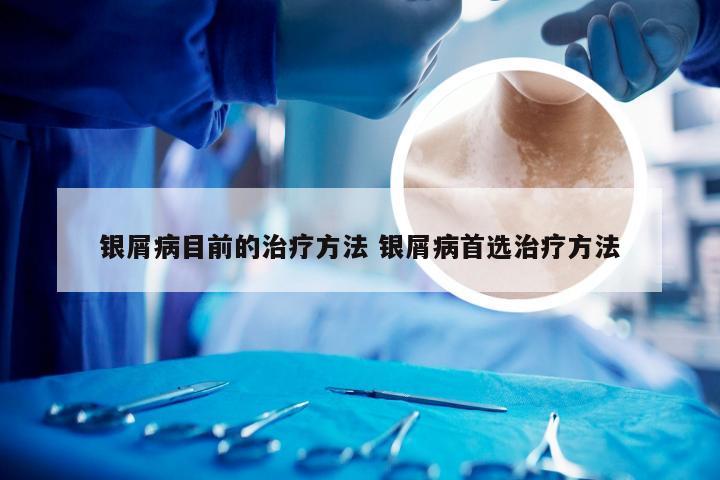 银屑病目前的治疗方法 银屑病首选治疗方法