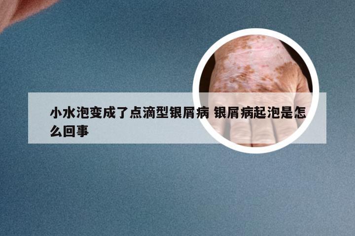 小水泡变成了点滴型银屑病 银屑病起泡是怎么回事