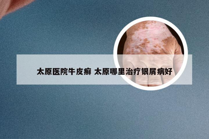 太原医院牛皮癣 太原哪里治疗银屑病好