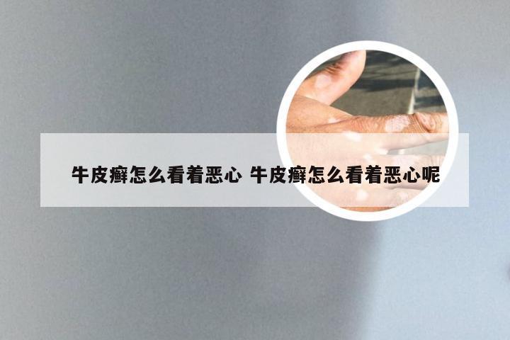 牛皮癣怎么看着恶心 牛皮癣怎么看着恶心呢
